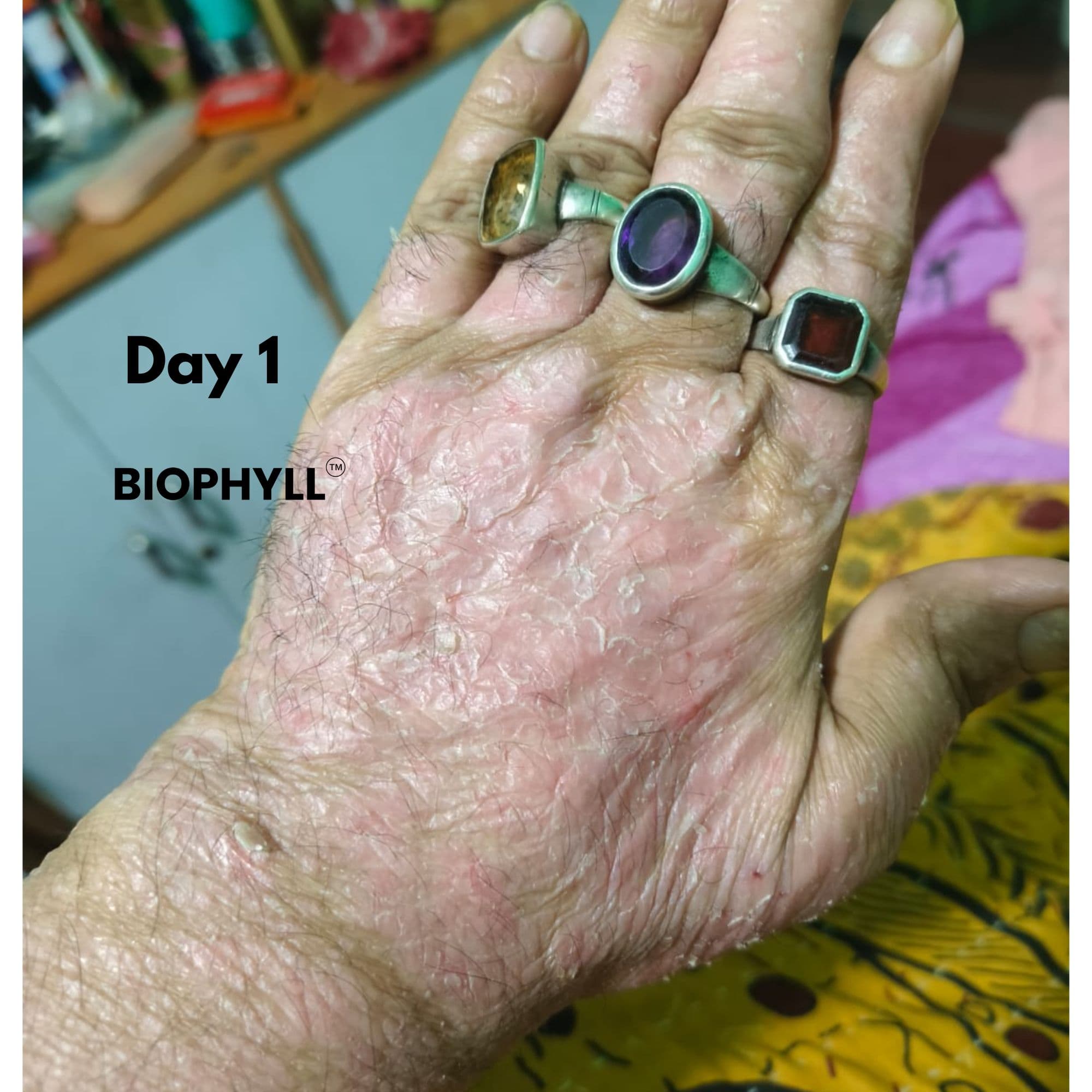 Rajesh Kulkarni Before - Biophyll Chlorophyllin real customer detox result